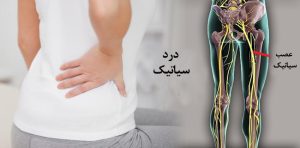 بهترین ورزش برای درد سیاتیک چیست؟ | درمان سیاتیک بدون جراحی درد سیاتیک چیست و چرا ایجاد می‌شود؟