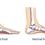 کف پای صاف (Flat Foot)