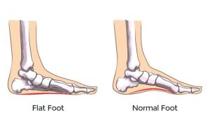 کف پای صاف (Flat Foot)