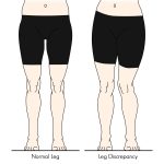 نابرابری طول پا (Leg Length Discrepancy); قاتل خاموش تقارن بدن