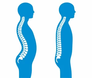 گودی کمر (Lordosis)