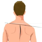 شانه گرد (Rounded Shoulders)