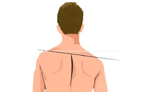 شانه گرد (Rounded Shoulders)