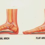 Pes Planus