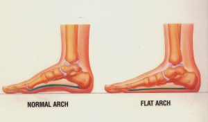 Pes Planus