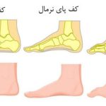 قوس بیش از حد کف پا (High Arch Foot)