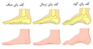قوس بیش از حد کف پا (High Arch Foot)