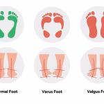 انحراف پاشنه (Heel Varus/Valgus)
