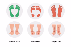 انحراف پاشنه (Heel Varus/Valgus)