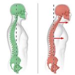 سر به جلو (Forward Head Posture)