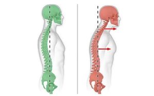 سر به جلو (Forward Head Posture)