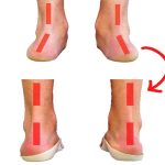 چرخش مچ پا به داخل (Overpronation)