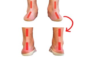 چرخش مچ پا به داخل (Overpronation)